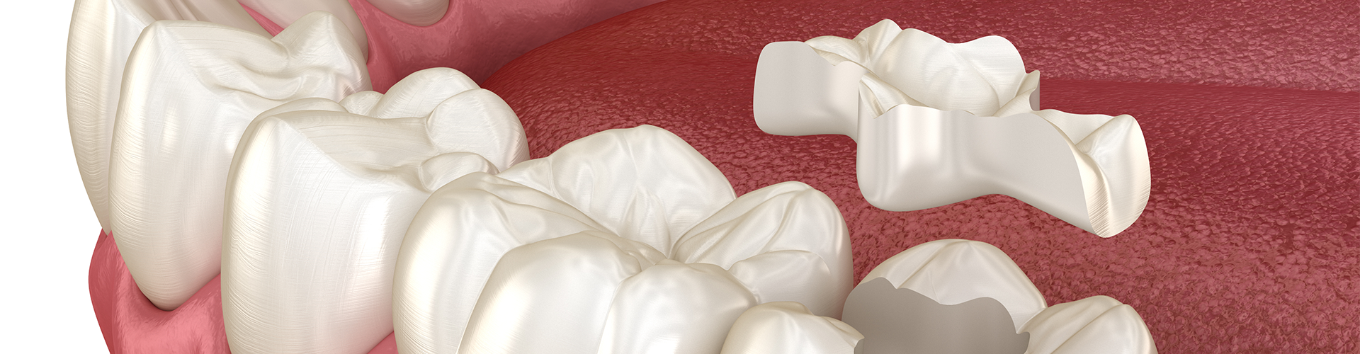 rendering of an inlay being placed in a molar
